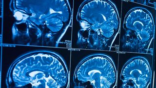 Study: CTE found in people with no history of contact sports (d)